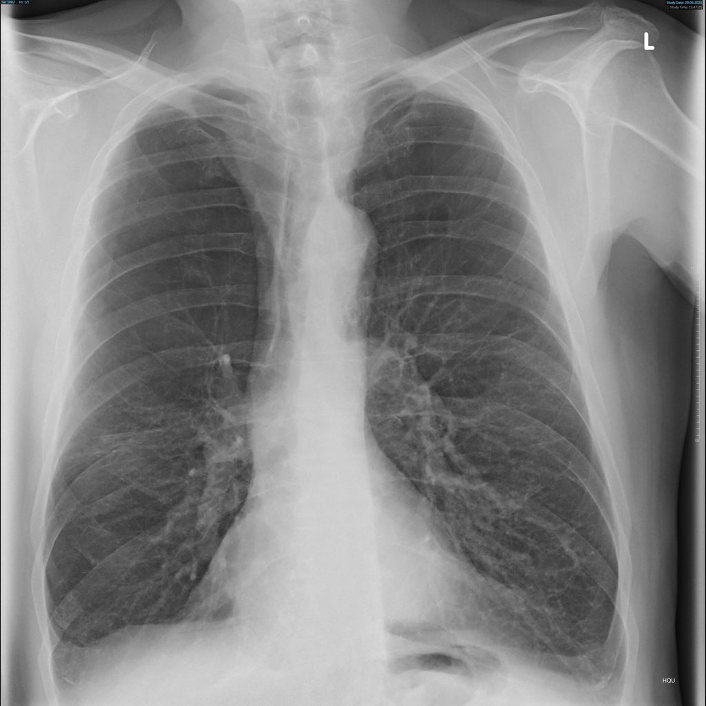 Die Lebensqualit t Bei Lungenemphysem Verbessern Pneumologie Die Lebensqualit t Bei Lungenemphysem Verbessern Pneumologie